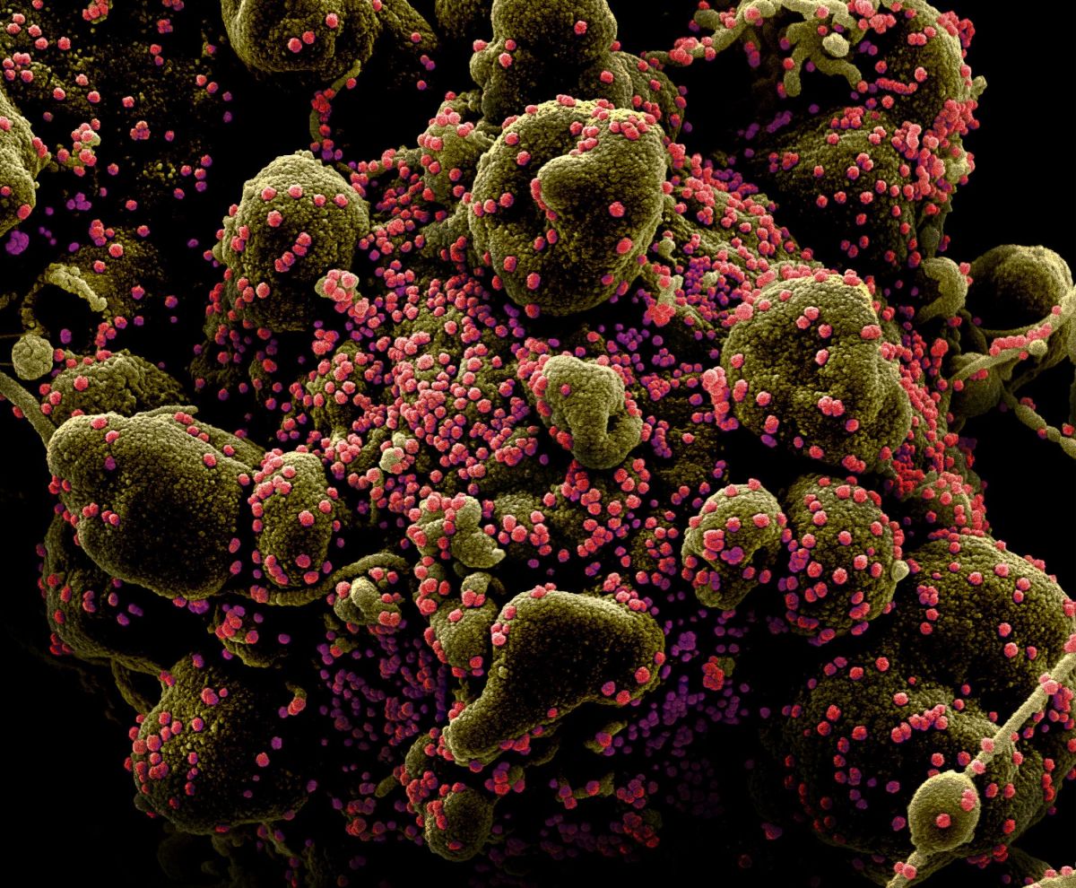 FILE PHOTO: Colorized scanning electron micrograph of an apoptotic cell heavily infected with SARS-COV-2 virus particles, also known as novel coronavirus